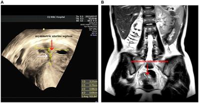 Diagnosis and treatment of Robert’s uterus combined with transverse uterine septum: a case report and review of the literature